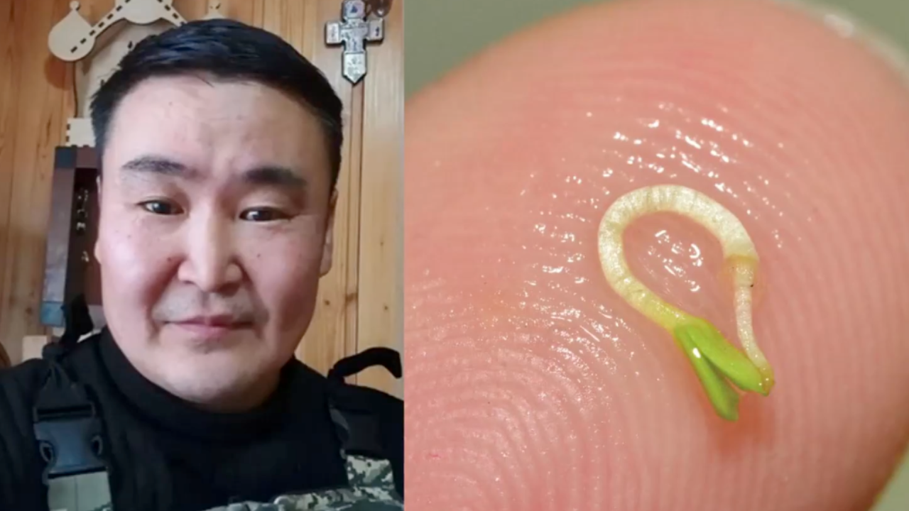 Doctors Find Sprouted Seed in Man's Eye After 4 Months | TrendingAmerican